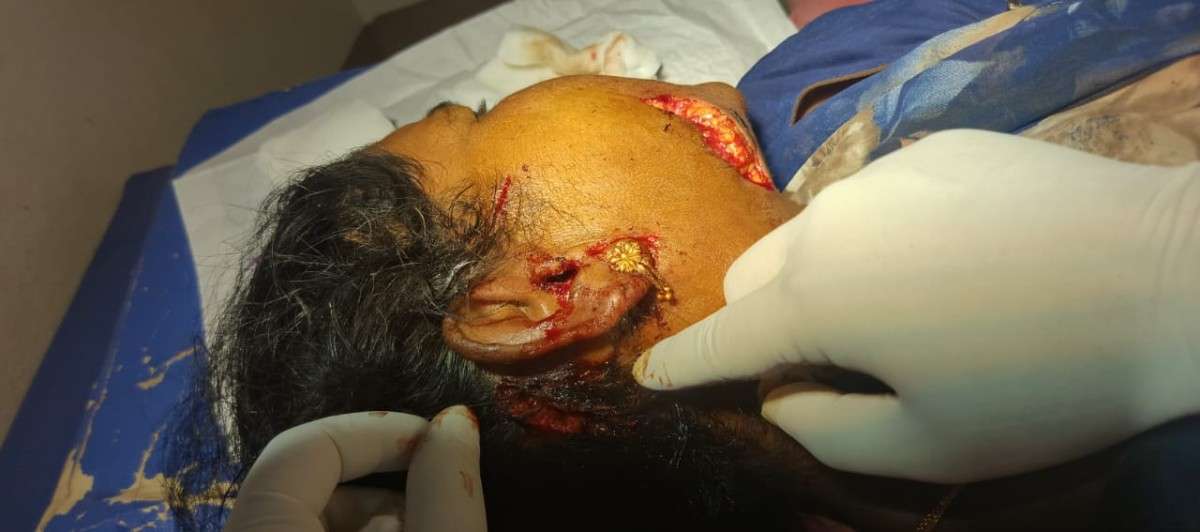 Wild Bear Attacks Chenchu Woman in Balmoor Forest; Hospitalized in Achampet
